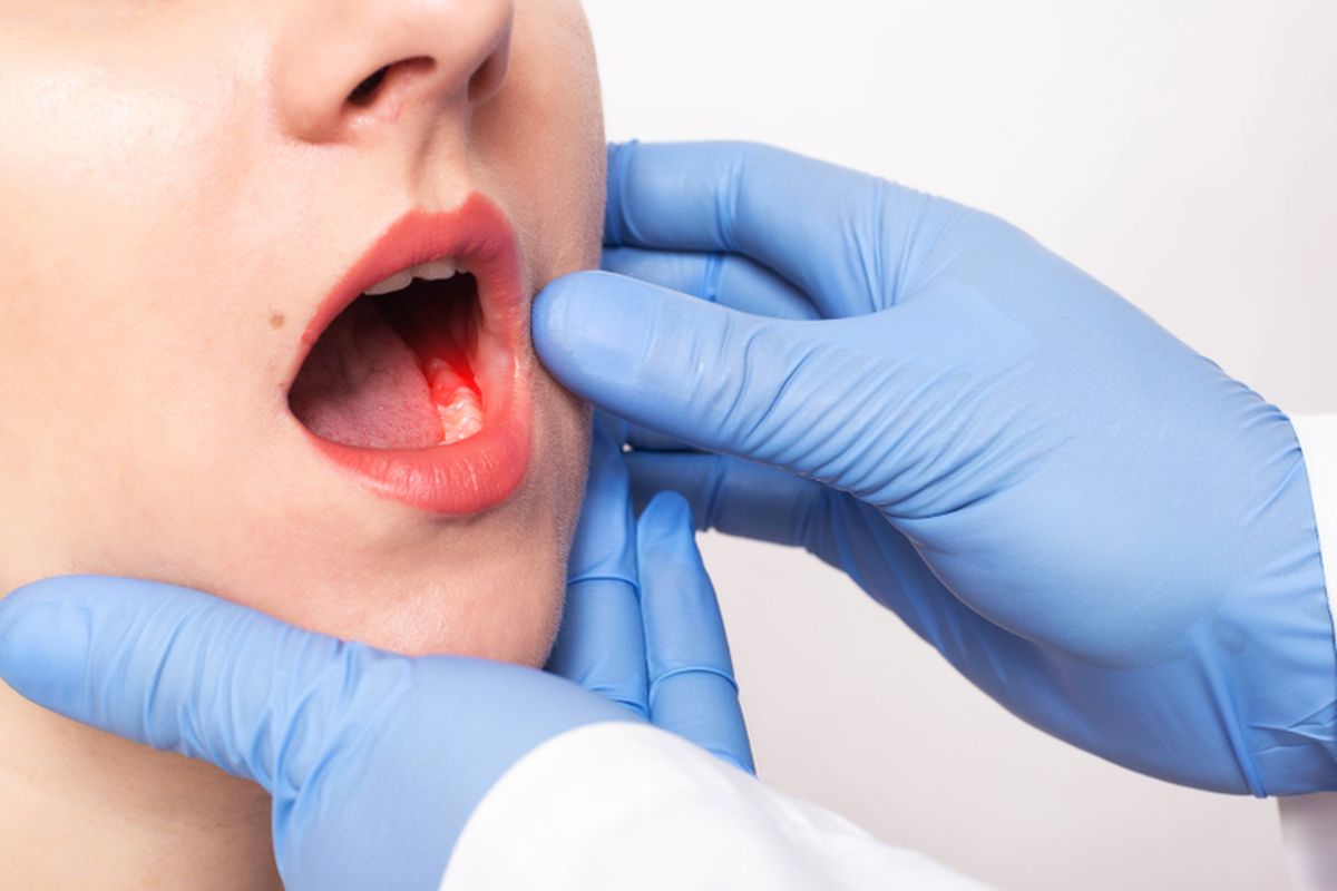 10 Cara Mengatasi Gusi Berdarah di Rumah